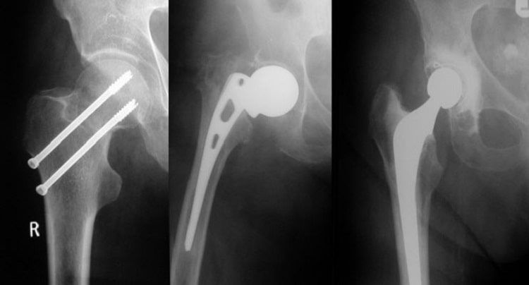 شکستگی مفصل ران در سالمندان, شکستگی هیپ, درمان شکستگی های هیپ
