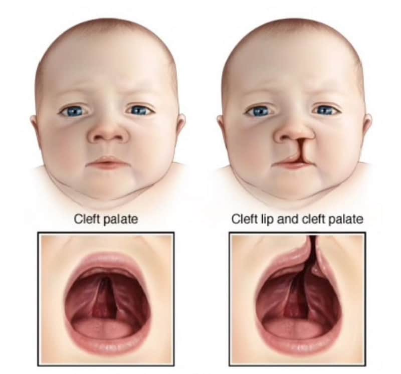 علل ایجاد شکاف های دهانی, شکاف کام و لب در کودکان