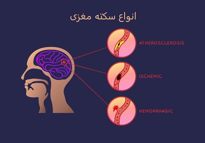 علائم سکته مغزی و جلوگیری از وقوع آن, علائم سکته مغزی, سکته مغزی چیست, انواع سکته مغزی, عوامل خطر قابل درمان در وقوع سکته مغزی, عوارض سکته مغری, سکته مغزی در زنان