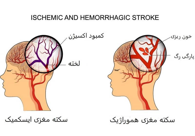 سکته مغزی هموراژیک, سکته مغزی ایسکمیک, علائم سکته مغزی و جلوگیری از وقوع آن, علائم سکته مغزی, سکته مغزی چیست, انواع سکته مغزی, عوامل خطر قابل درمان در وقوع سکته مغزی, عوارض سکته مغری, سکته مغزی در زنان