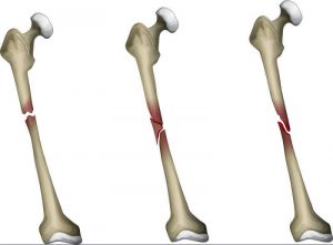 شکستگی استخوان ران