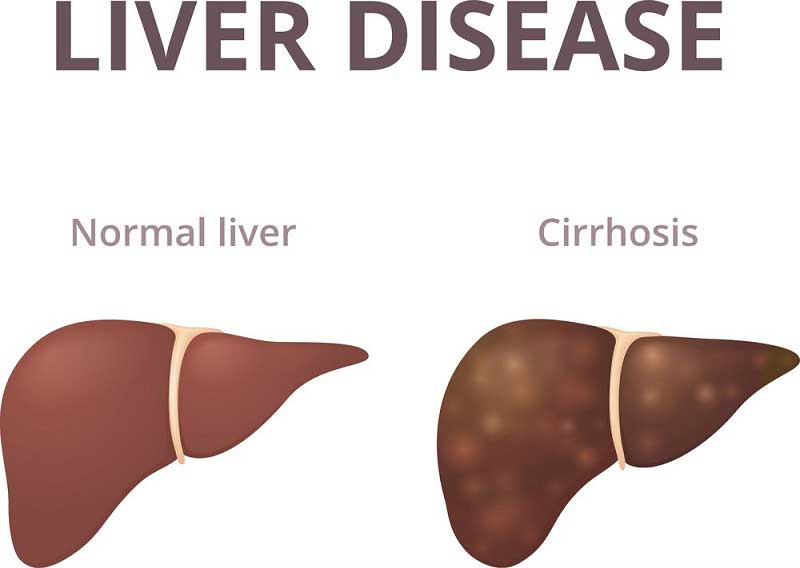 علائم بیماریهای کبدی