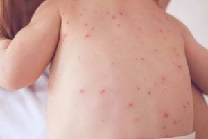 سرخک, سرخک در کودکان, سرخک در بچه ها, مراقبت از کودک مبتلا به سرخک, measles in children, مراقبت در منزل از کودک مبتلا به سرخک, پرستاری از کودک مبتلا به سرخک