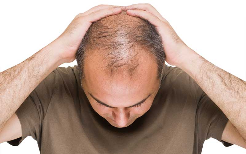 ریزش مو در فرد مبتلا به تیروئید - علائم ابتلا به تیروئید - علائم تیروئید ریزش مو