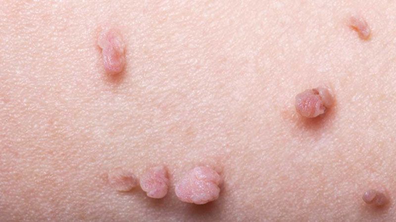 علت ایجاد علائم زگیل تناسلی چیست؟ - فرق زگیل تناسلی با جوش