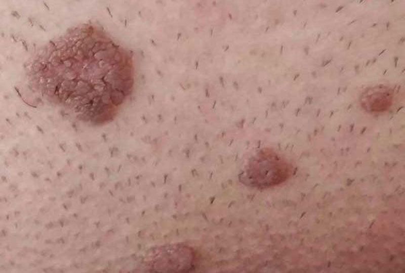 عوامل خطر زگیل تناسلی, عوارض احتمالی hpv