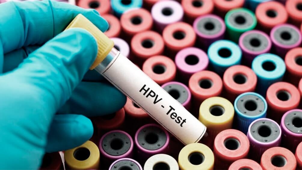 آزمایش فوری ویروس hpv
