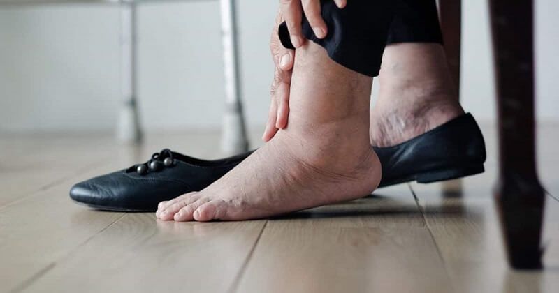 درمان ورم پای سالمندان در منزل