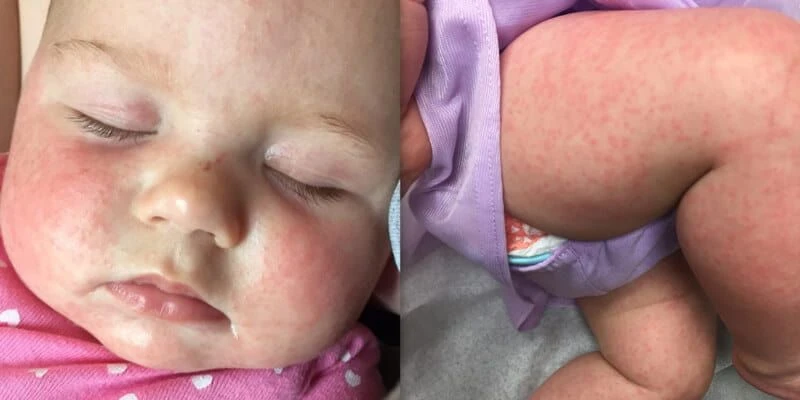 عکس سرخک روی صورت و پای کودک