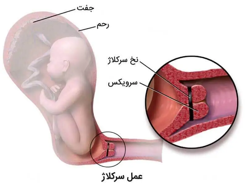 عکس از ساختار رحم و مکان بچه که باعث می‌شود عمل سرکلاژ انجام شود.