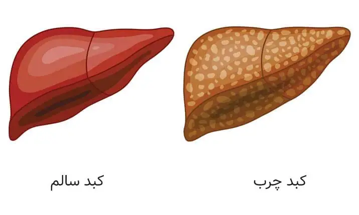 راه های تشخیص کبد چرب