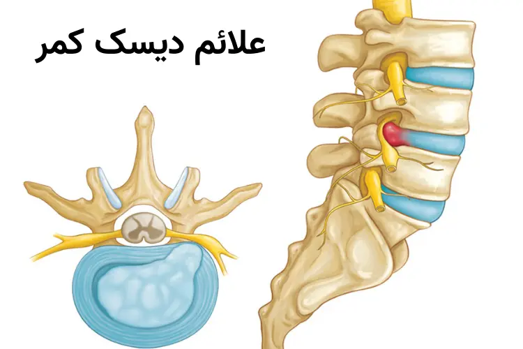 عکس دیسک کمر