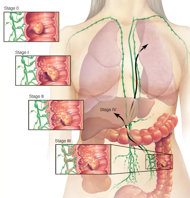 آناتومی سرطان معده در مراحل مختلف