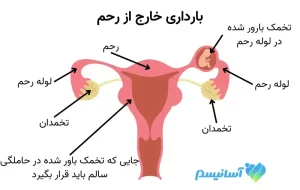آناتومی بارداری خارج از رحم