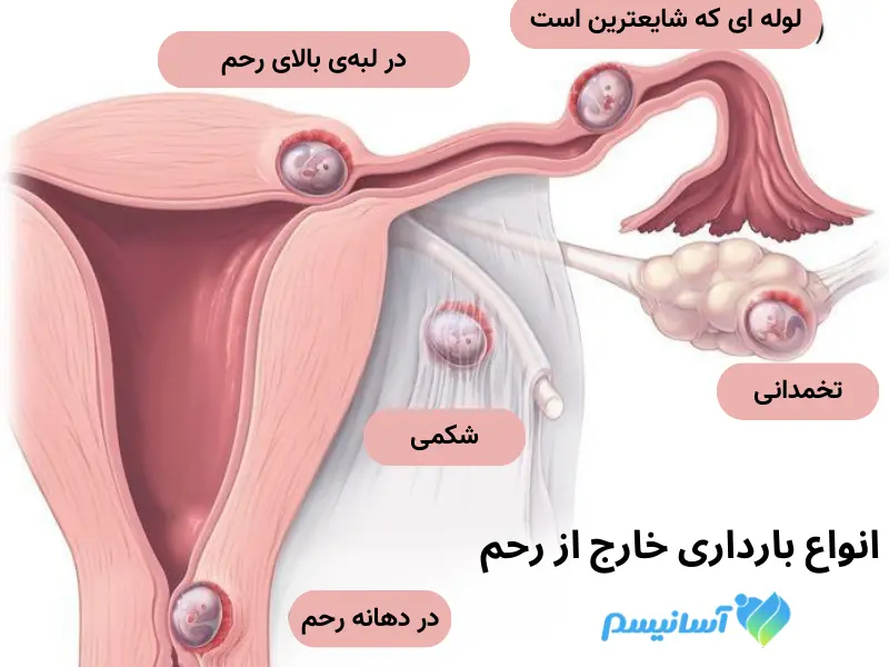 مناطق مختلف بارداری قبل از رحم